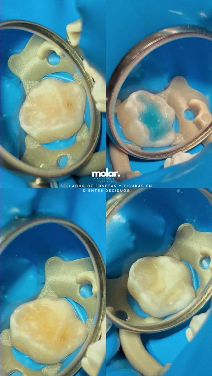 Cuatro vistas de un molar de leche durante la colocación de un sellador de fosetas y fisuras, con aislamiento de goma dique